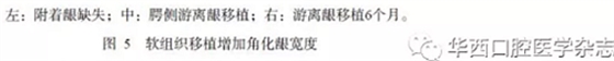 【專家共識】種植修復(fù)臨床評價標(biāo)準(zhǔn)