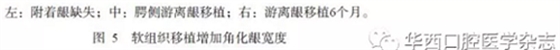【專家共識】種植修復(fù)臨床評價標(biāo)準(zhǔn)