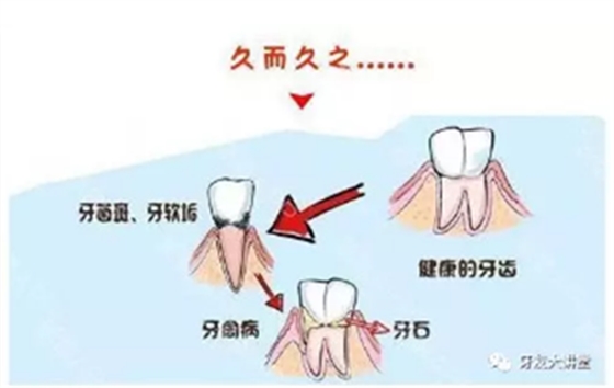 牙周炎，中國(guó)成年人后半生永遠(yuǎn)的 痛 ！