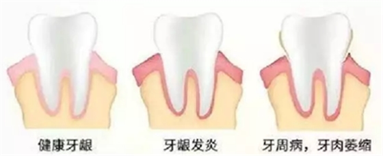 牙周炎，中國(guó)成年人后半生永遠(yuǎn)的 痛 ！