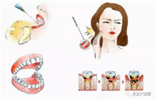 牙周炎，中國(guó)成年人后半生永遠(yuǎn)的 痛 ！
