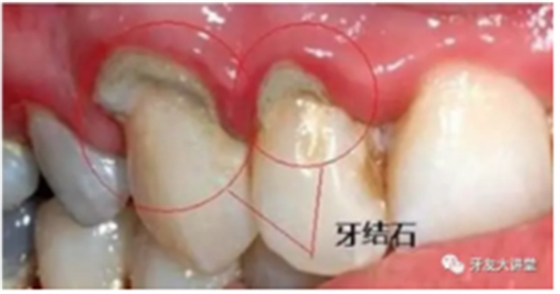牙周炎，中國(guó)成年人后半生永遠(yuǎn)的 痛 ！