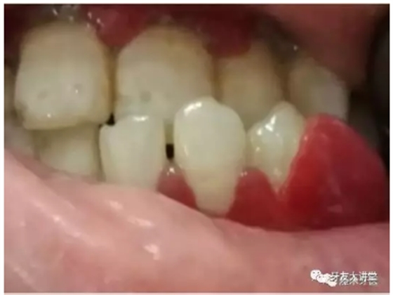 牙周炎，中國(guó)成年人后半生永遠(yuǎn)的 痛 ！