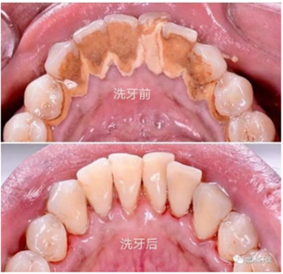 牙周炎，中國(guó)成年人后半生永遠(yuǎn)的 痛 ！
