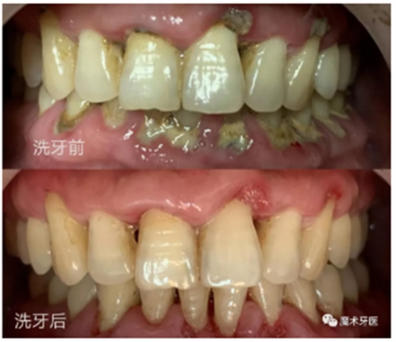 牙周炎，中國(guó)成年人后半生永遠(yuǎn)的 痛 ！