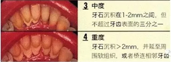 牙周炎，中國(guó)成年人后半生永遠(yuǎn)的 痛 ！
