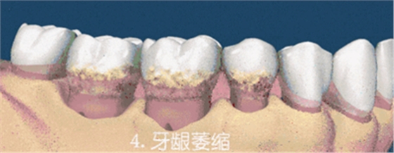 牙齦萎縮怎么辦？
