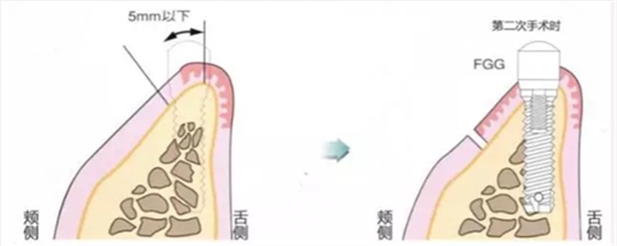 種植體周圍角化齦的獲得時(shí)期與方法
