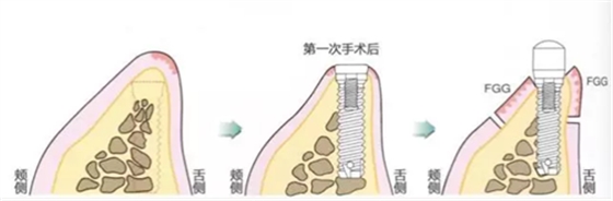 種植體周圍角化齦的獲得時(shí)期與方法