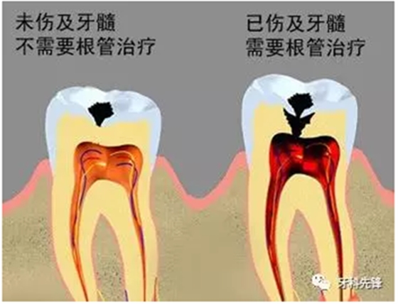 補(bǔ)牙不做冠，療效少一半！根管治療后牙齒已經(jīng)不疼了，為什么還要戴牙冠呢？