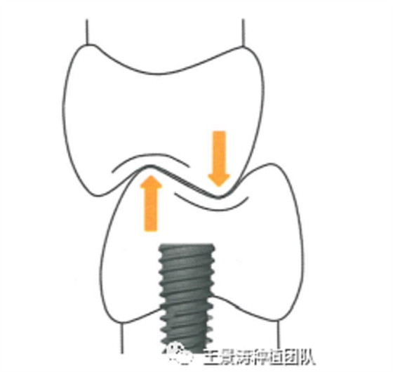 后牙區(qū)即刻種植的適應癥的思考
