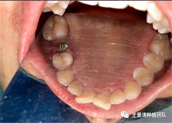 后牙區(qū)即刻種植的適應癥的思考