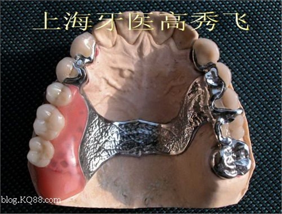 圖解后牙精密附著體修復(fù)2例（原創(chuàng)）