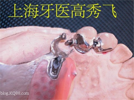 圖解后牙精密附著體修復(fù)2例（原創(chuàng)）