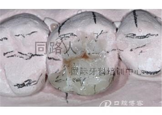 樹脂嵌體制作的階段性總結(jié)