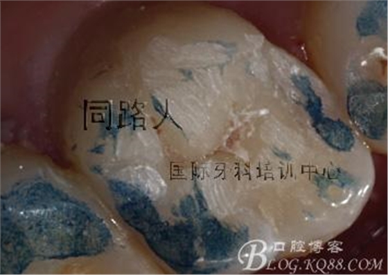 樹脂嵌體制作的階段性總結(jié)