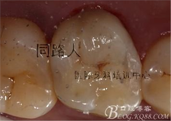 樹脂嵌體制作的階段性總結(jié)