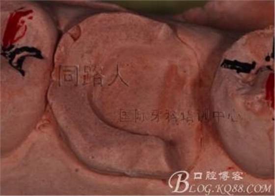 樹脂嵌體制作的階段性總結(jié)