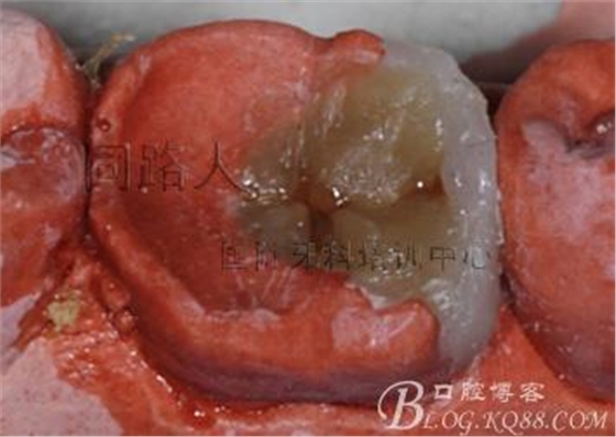 樹脂嵌體制作的階段性總結(jié)