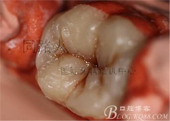 樹脂嵌體制作的階段性總結(jié)