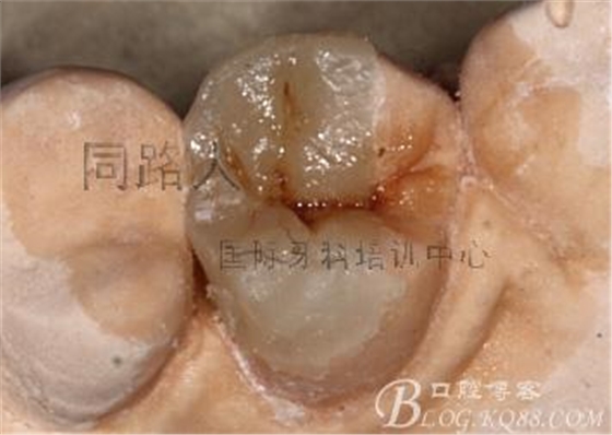 樹脂嵌體制作的階段性總結(jié)