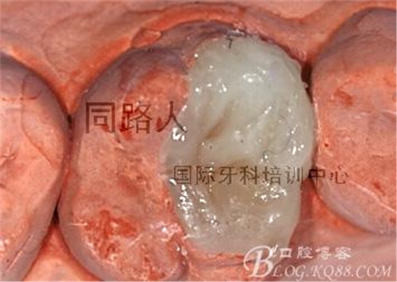 樹脂嵌體制作的階段性總結(jié)
