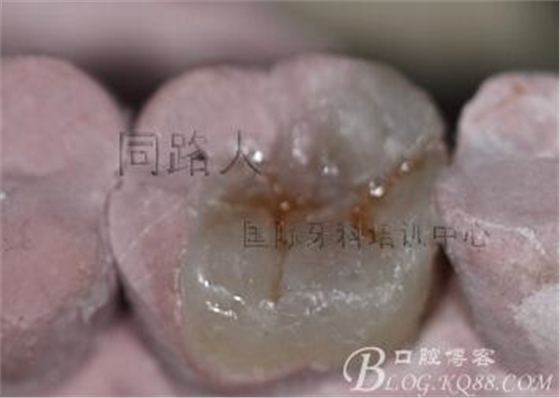 樹脂嵌體制作的階段性總結(jié)
