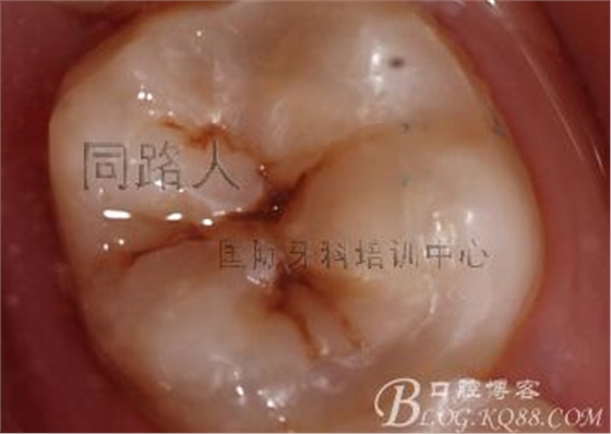 樹脂嵌體制作的階段性總結(jié)