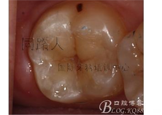 樹脂嵌體制作的階段性總結(jié)