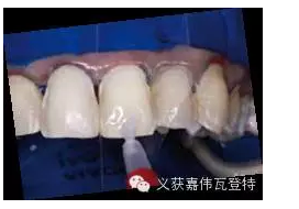 義獲嘉貼面粘接的操作步驟！