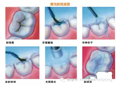 口腔窩溝封閉，就如同給牙齒穿上了一層保護(hù)衣，使牙齒免受食物侵蝕。原理：窩溝封閉后，窩溝內(nèi)原有的細(xì)菌斷。