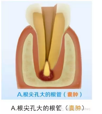 讓你知道根管測(cè)量受影響的原因