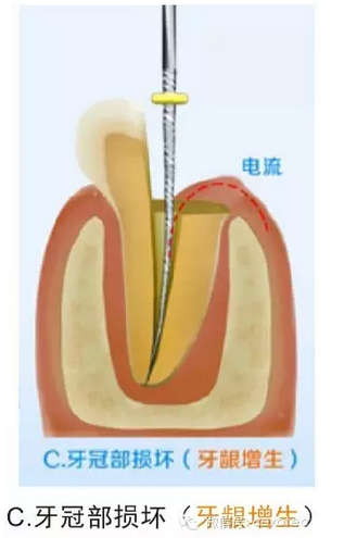 讓你知道根管測(cè)量受影響的原因