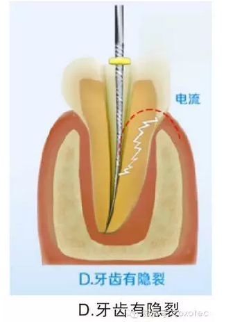 讓你知道根管測(cè)量受影響的原因