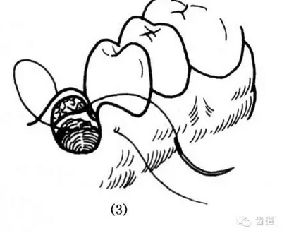 牙醫(yī)基本技能：口內(nèi)縫合術(shù)（文字、示意圖及視頻）