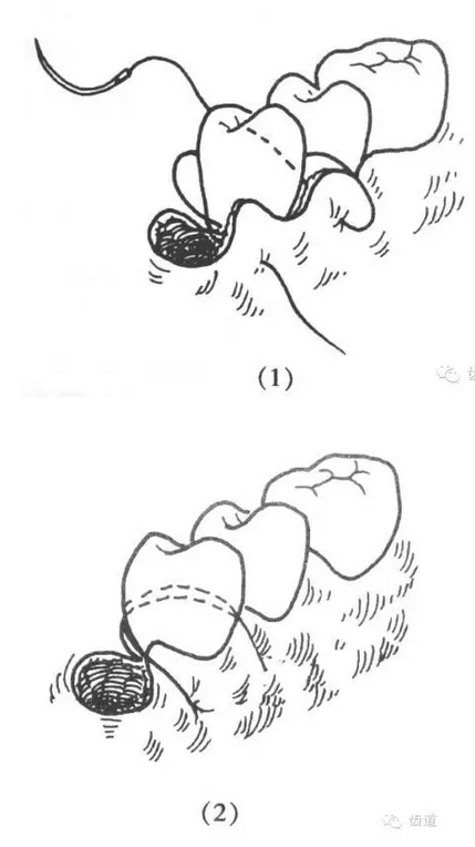 牙醫(yī)基本技能：口內(nèi)縫合術(shù)（文字、示意圖及視頻）