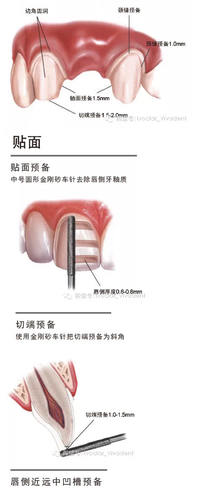 時常搞不清楚怎么備牙嗎？義獲嘉教您如何完美備牙