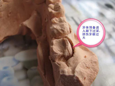 備牙應(yīng)注意的事項(xiàng)+備牙取摸損傷牙齦問題