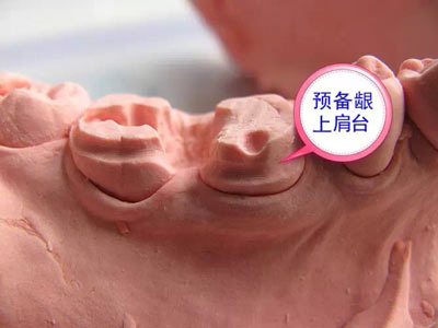 備牙應(yīng)注意的事項(xiàng)+備牙取摸損傷牙齦問題
