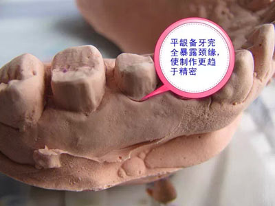 備牙應(yīng)注意的事項(xiàng)+備牙取摸損傷牙齦問題