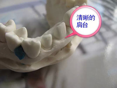 備牙應(yīng)注意的事項(xiàng)+備牙取摸損傷牙齦問題