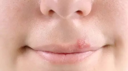 這十種常見口腔疾病，你有遇到過么？