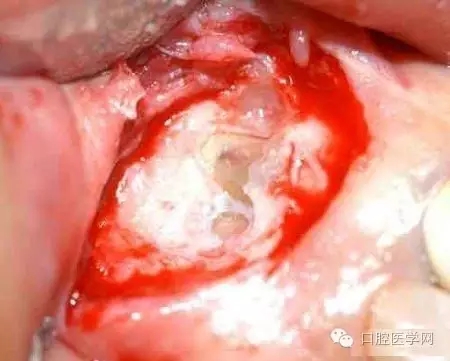 根尖切除術(shù)操作全過(guò)程