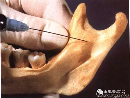 即使是老手也會失手的麻醉----下牙槽、舌、頰一次阻滯麻醉