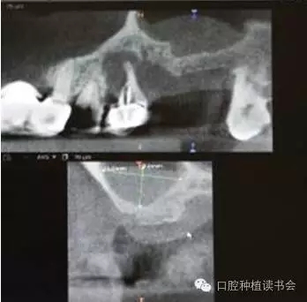 上頜后牙區(qū)種植治療的關鍵技術之—上頜竇提升術