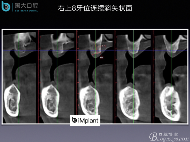 上頜竇底區(qū)域嚴重骨吸收的臨床種植案例.jpeg