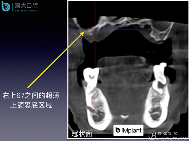 上頜竇底區(qū)域嚴重骨吸收的臨床種植案例.jpeg