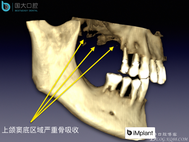 上頜竇底區(qū)域嚴重骨吸收的臨床種植案例.jpeg