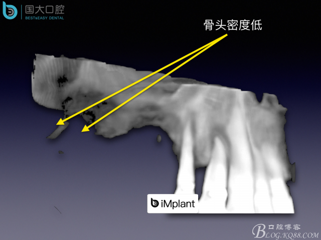 上頜竇底區(qū)域嚴重骨吸收的臨床種植案例.jpeg