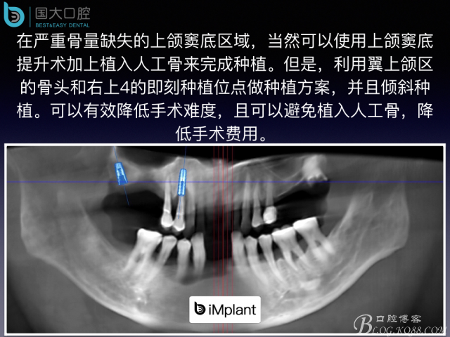 上頜竇底區(qū)域嚴重骨吸收的臨床種植案例.jpeg